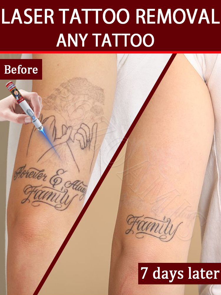 Laser Toner Powder - Nano laser tattooʀᴇᴍᴏᴠᴀʟ ᴘᴇɴ: Highly effective